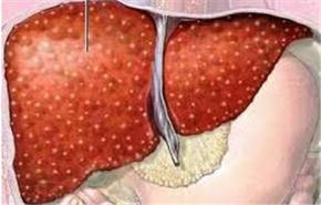 الكبد الدهني يزيد خطر الإصابة بمرض في القلب