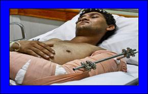 زرع ذراع مقطوعة لأول مرة بايران   