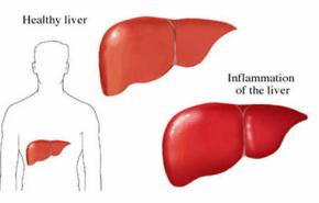 غالبية الأمريكيين لا يحصلون على المصل المضاد لالتهاب الكبد الوبائى 