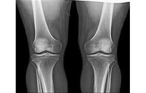 إيران.. التوصل إلى صناعة عظام اصطناعية