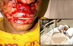 طفل بحريني يفقد إحدى عينيه اثر اصابته بنيران الأمن