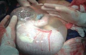 تولد نادر یک نوزاد درون کیسه آب + عکس