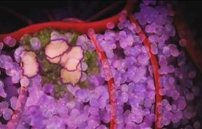 السرطان وطرق علاجه