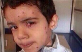 تصاویر؛ گلوله‌های ساچمه‌ای در صورت کودک بحرینی