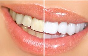 بالصور/طريقة فعالة لتبييض الاسنان تغنيك عن زيارة الطبيب