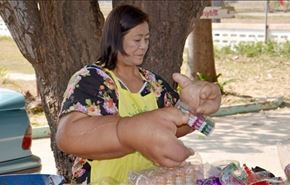تايلاندية بأكبر ذراعين في العالم بسبب مرض نادر