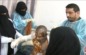 اطباء يمنيون يؤكدون وجود اصابات كيميائية او بيولوجية+فيديو