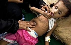 كم طفل يعاني من سوء التغذية باليمن؟ عدد لا يصدق!