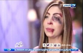 بالفيديو مذيعة تظهر على الهواء بكدمات والسبب..؟!