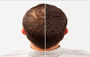 التغذية المناسبة لتقوية الشعر