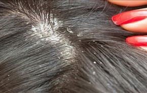 جرّبوها ولن تندموا.. هذه 5 علاجات نهائية لقشرة الشعر