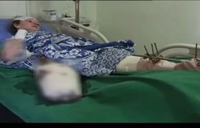 فيديو.. أم روسية في حلب تفقد ساقها ويدها لتحمي أولادها!