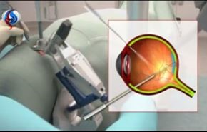 ویدیو: موفقیت اولین جراحی چشم با ربات