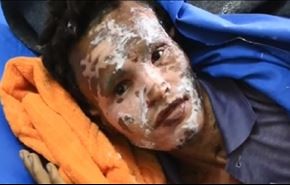 بالفيديو: اسلحة محرمة تذيب العظام تمطر السعودية بها اليمنيين