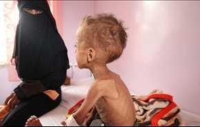 الصحة العالمية تعلن ارتفاع عدد حالات الكوليرا في اليمن