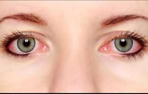 قرمز شدن چشم، علل و راه‌های درمان