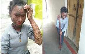 «شاهد» الفتاة الثعبان .. تتساقط بشرتها كل 6 أسابيع ولا علاج!