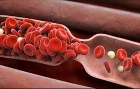 تخثر الدم .. اسبابه وعلاجاته