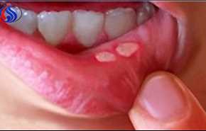 آفت دهان چگونه درمان می‌شود؟
