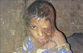 طفلة ذاب وجهها بسبب والديها.. أخيرًا تلقى العلاج!