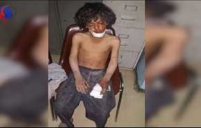 صورة مؤلمة لطفل اصيب جراء انفجار قنبلة عنقودية في الصفراء بصعدة