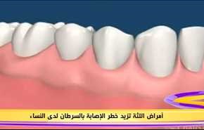 أمراض اللثة تزيد خطر الإصابة بالسرطان لدى النساء