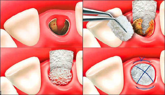 طبيب ايراني يبدع طريقة جديدة بجراحة اللثة وزرع الاسنان  