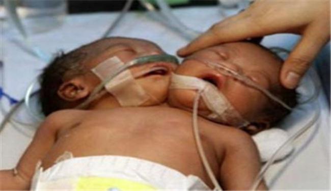 ولادة طفل برأسين في البرازيل 
