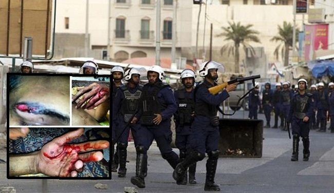 صور/الامن البحريني يعذّب معتقلين بالأمواس وأعواد السجائر