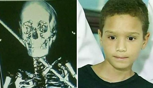 Boy pierced by 2ft iron bar in his neck survives