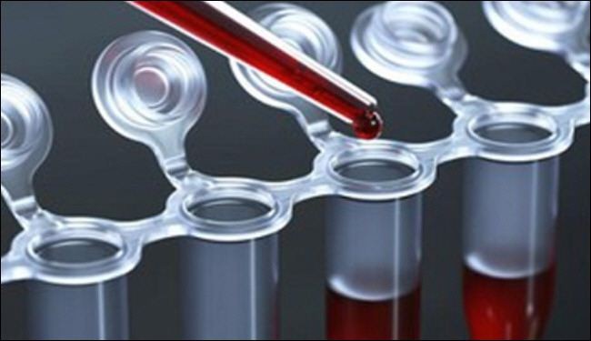 علماء إيرانيون يساهمون في ابداع فحص للدم لتشخيص السرطان