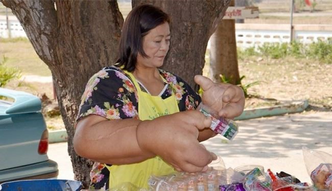 تايلاندية بأكبر ذراعين في العالم بسبب مرض نادر