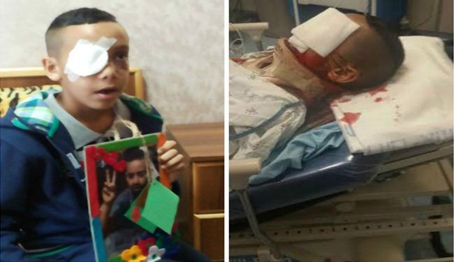 طفل فلسطيني خرج لشراء الفلفل ففقد عينه برصاص الاحتلال