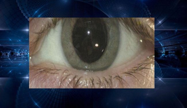 اكتشاف جديد لعلاج العمى باستخدام الجينات