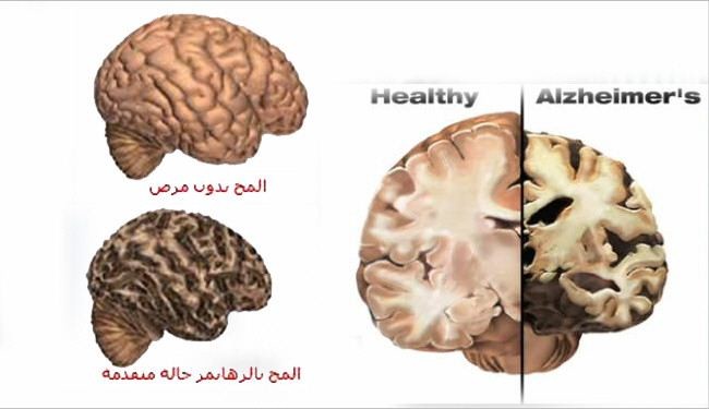 كيف يدمر مرض الزهايمر الدماغ‏؟