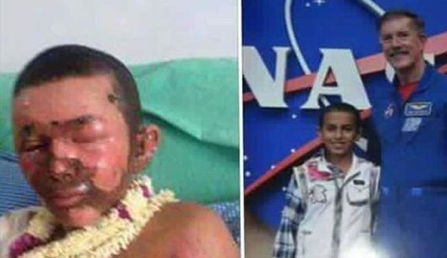 طفل اليمن المعجزة ضحية العدوان السعودي