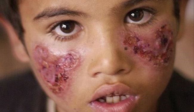 ISIS Spreading ‘Flesh-Eating’ Disease in Syria as a Biologic Weapon