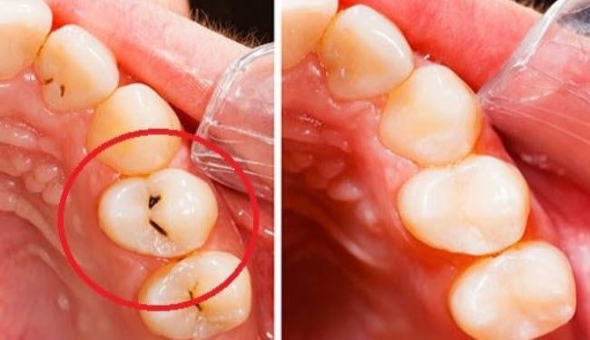 وصفة طبيعية للتخلص من تسوس الأسنان و إزالة الجير