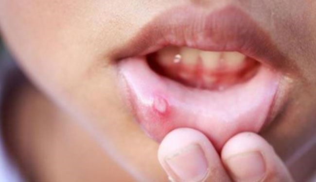 هل تعاني من قرح الفم المؤلمة؟ اليك الأسباب