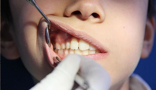 دراسة طبية: التهابات الأسنان تفاقم الإصابة بأمراض القلب