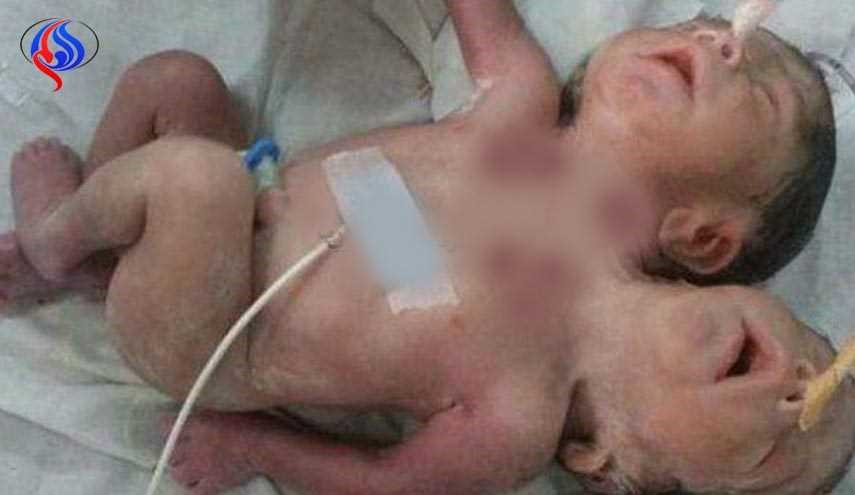 ولادة طفل برأسين وثلاثة أيدي في الهند!