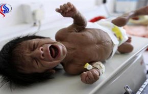 تحذير أممي من “المجاعة الاضخم” في اليمن بسبب الحصار +فيديو
