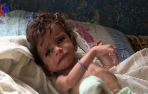 بالفيديو ...الامم المتحدة تدق ناقوس خطر ارتفاع المجاعة في اليمن