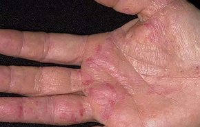 العوارض الأولى للسرطان تظهر على اليدين! كيف تكتشفونها؟