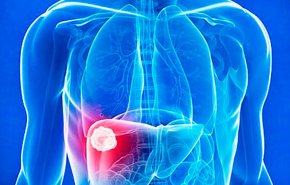 دراسة: العلاج الإشعاعي خيار فعال لمرضى سرطان الكبد