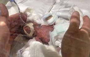 ولادة أصغر طفل في العالم بوزن يبلغ 268 غراما