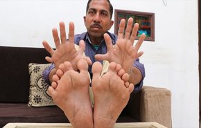 هندي يدخل غينيس بامتلاكه أكبر عدد أصابع في العالم