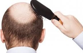 تساقط الشعر يكشف عن مشكلات صحية خطيرة