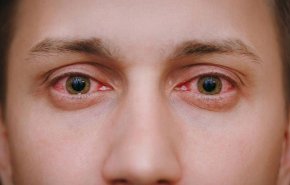 احذروا احمرار العين أثناء الاصابة بكورونا