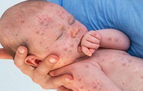 اليونيسف تحذر من تفشي مرض خطير مع الإنشغال بكورونا